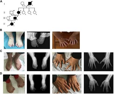 A Novel Nonsense GLI3 Variant Is Associated With Polydactyly and Syndactyly in a Family by Blocking the Sonic Hedgehog Signaling Pathway